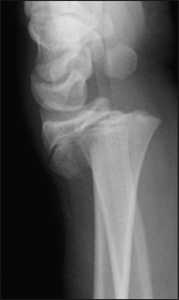 Fracture_Distal radius physeal_Figure 3_1370609-Salter-Harris2_lateral.jpg